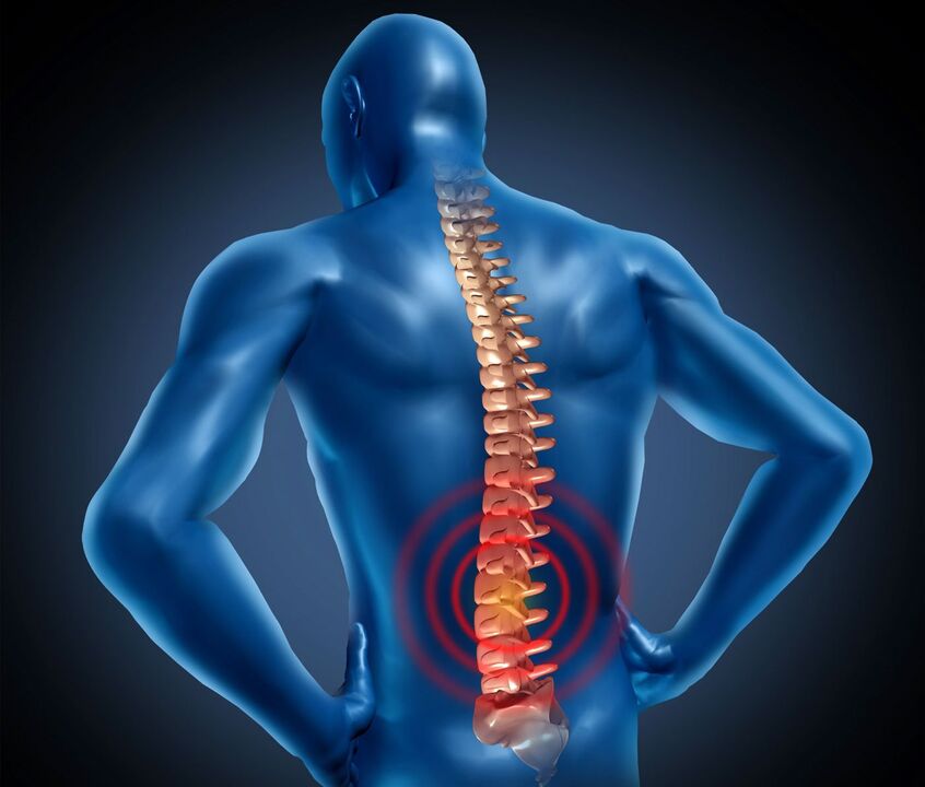 Lumbar osteochondrosia
