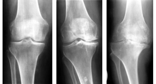 Belauneko artrosia identifikatzeko derrigorrezko diagnostiko-neurri bat erradiografia da